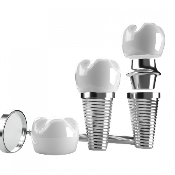 6 dažniausiai užduodami klausimai prieš danties implantaciją