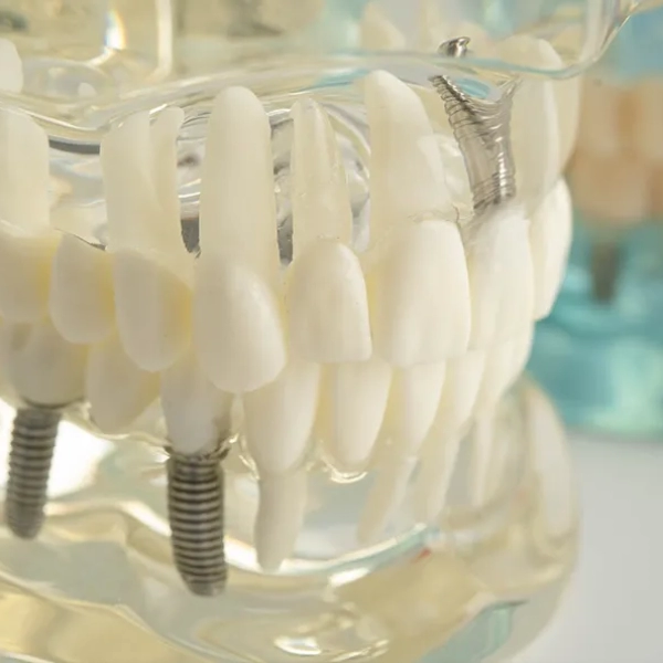 „MAXILLA-FOR-ALL“ – ne burtažodis, o sprendimas naujiems dantims vos per vieną vizitą