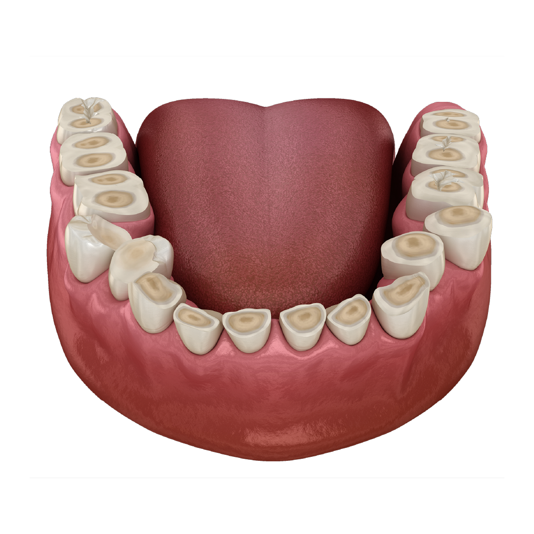 Dantų griežimo ir dilimo profilaktika (bruksizmo gydymas)